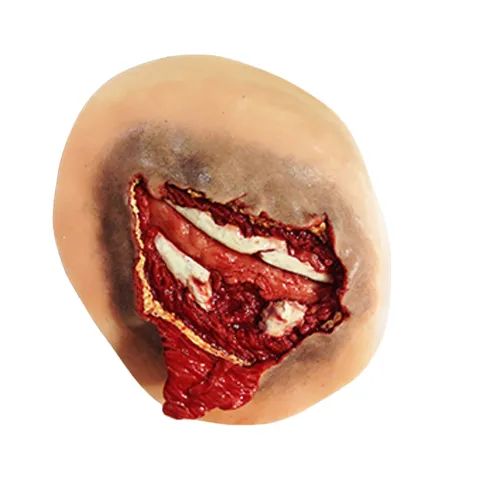 Simulaids Open Rib Fracture